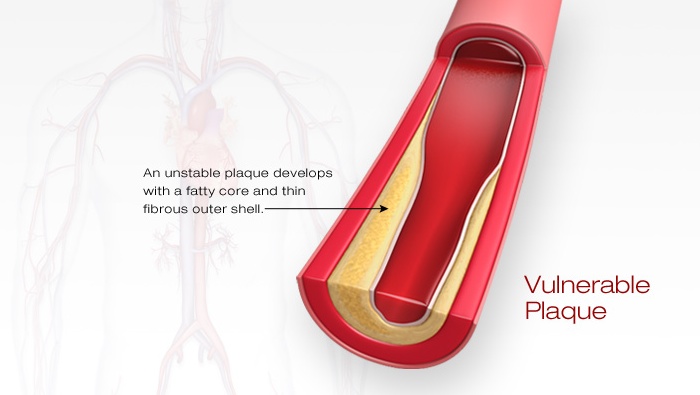 Atherosclerosis Stroke