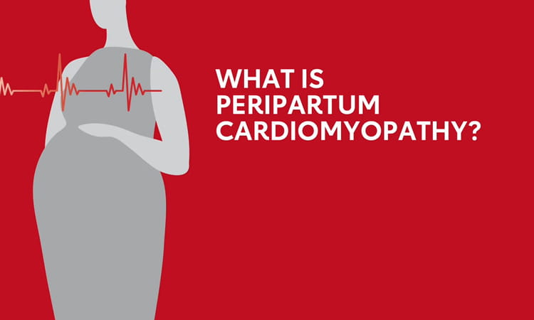 Peripartum Cardiomyopathy Animation video screenshot
