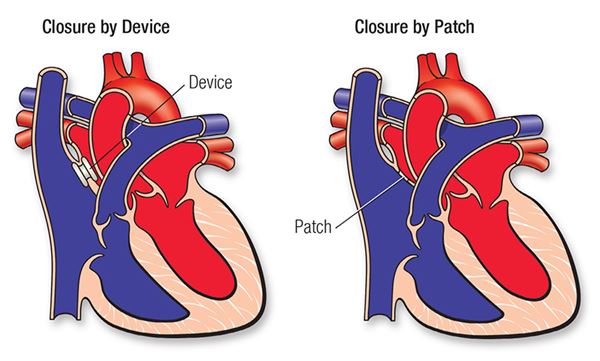 ASD repairs diagram